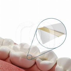 DENTAPREG PFU SINGLE (6CM)