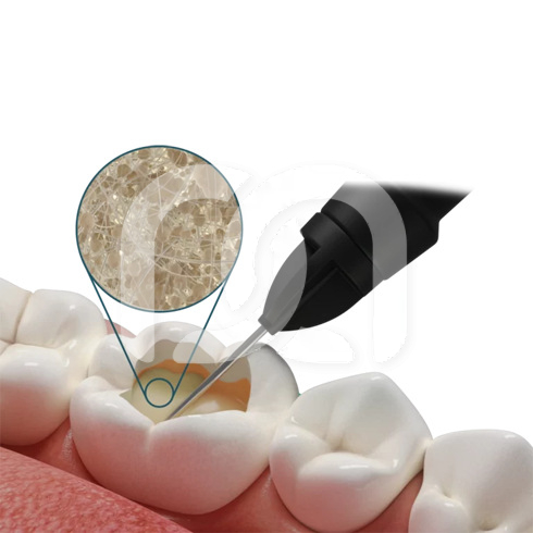 FIBRAFILL FLOW (2ML)