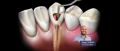 Hoe de juiste endodontistische vijl kiezen?