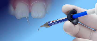 HOE HERSTEL JE EEN MARGINALE GLAZUUR CHIP?