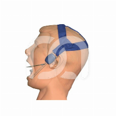 Trekhoofdkap voor Orthodontische Tractie Large (5)
